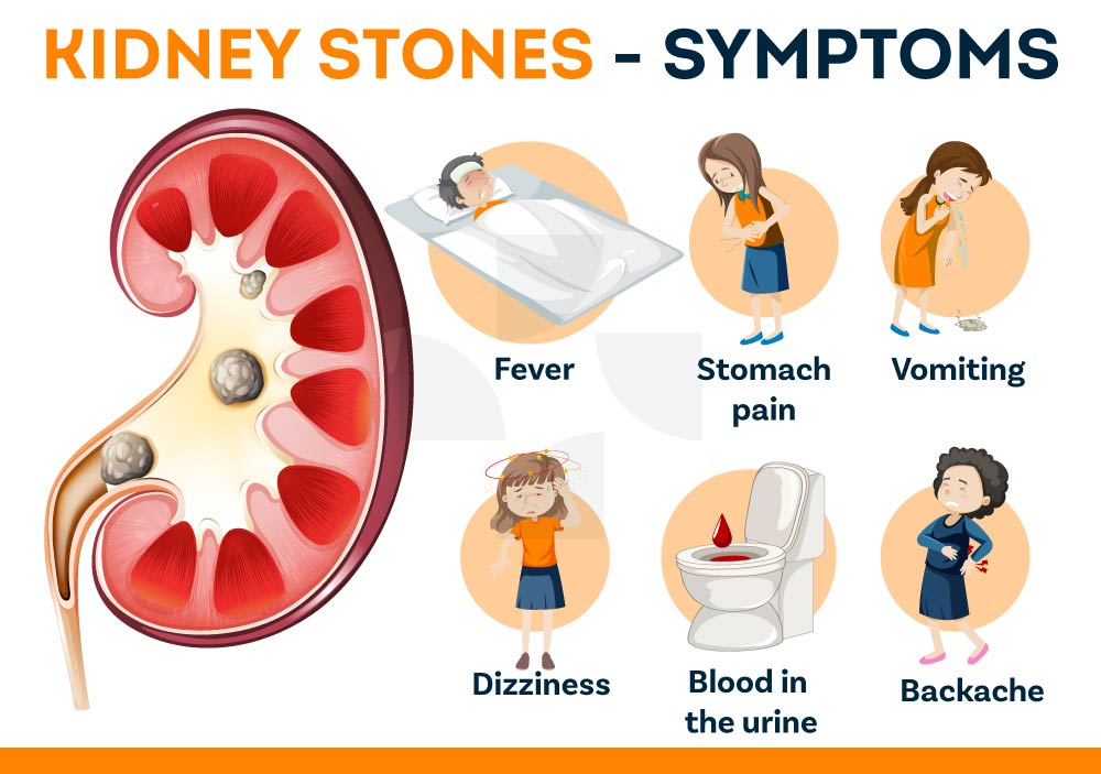 Kidney Stone Symptoms 1