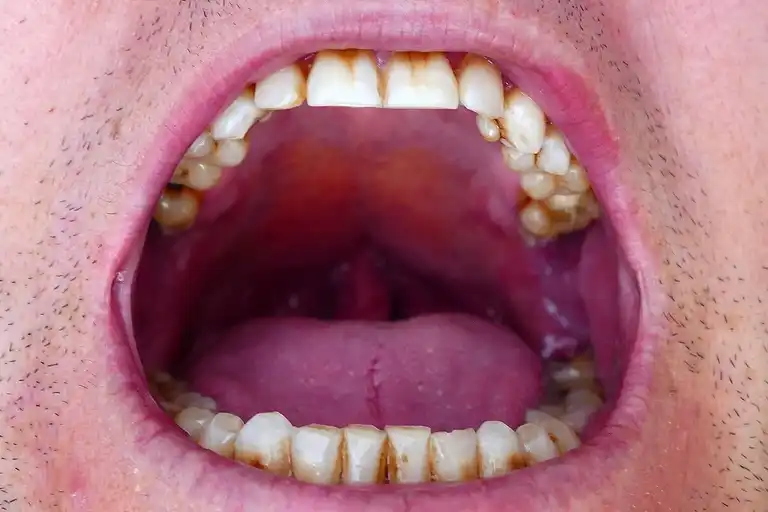 ¿Qué es la Mácula Melanótica Oral?
